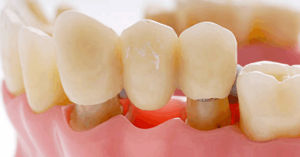 Close-up of a dental bridge model showing crowns attached to abutment teeth over a gum-colored base.