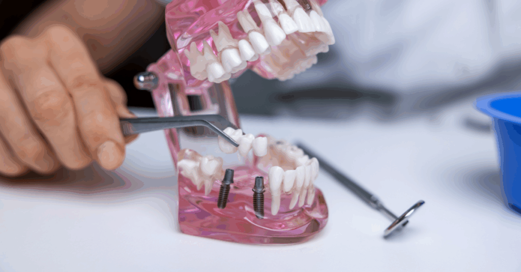Close-up of a dental implant model showing artificial teeth being placed onto two visible implant posts with dental tools