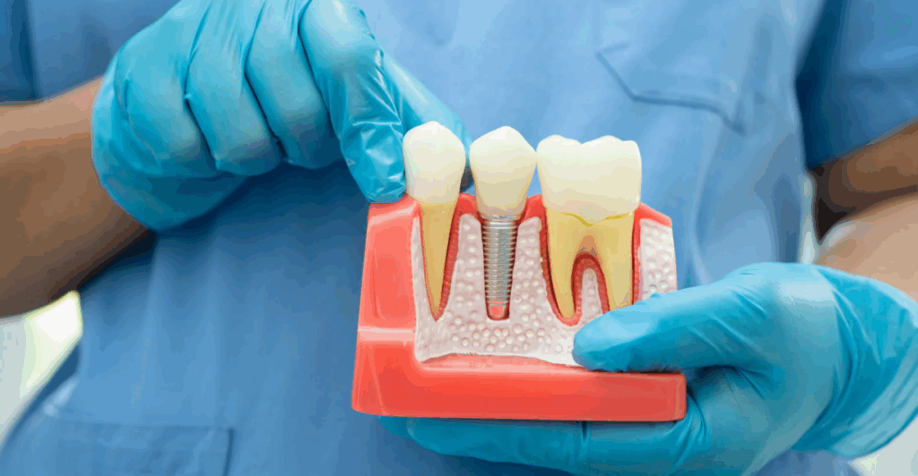 Close-up of a dental professional holding a model of a single tooth implant—illustrating how it fits securely into the jaw for lasting support.