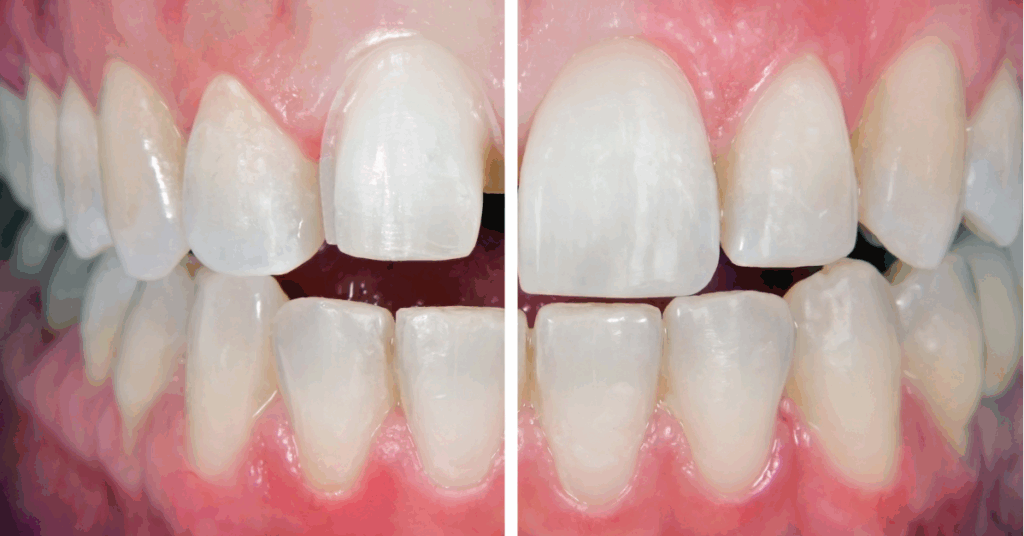 Close-up before and after comparison of teeth showing improved alignment, color, and shape following dental treatment.