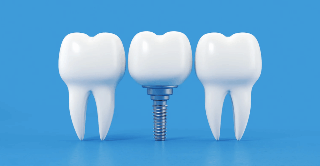 (3D illustration of two natural teeth with a dental implant in between, featuring a metal post and crown on a blue background.)