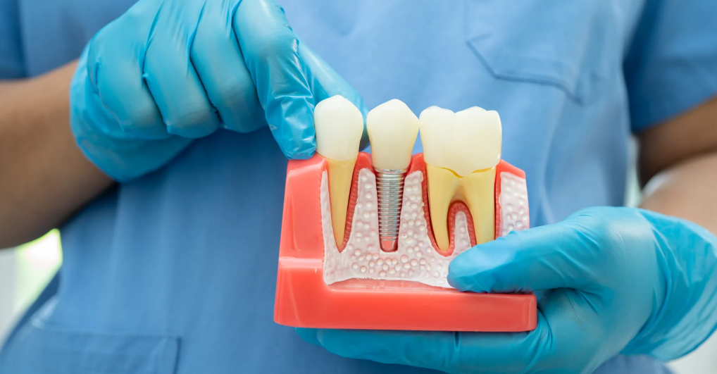 Dentist wearing blue gloves holding a cross-section model of teeth and pointing to a dental implant between natural teeth