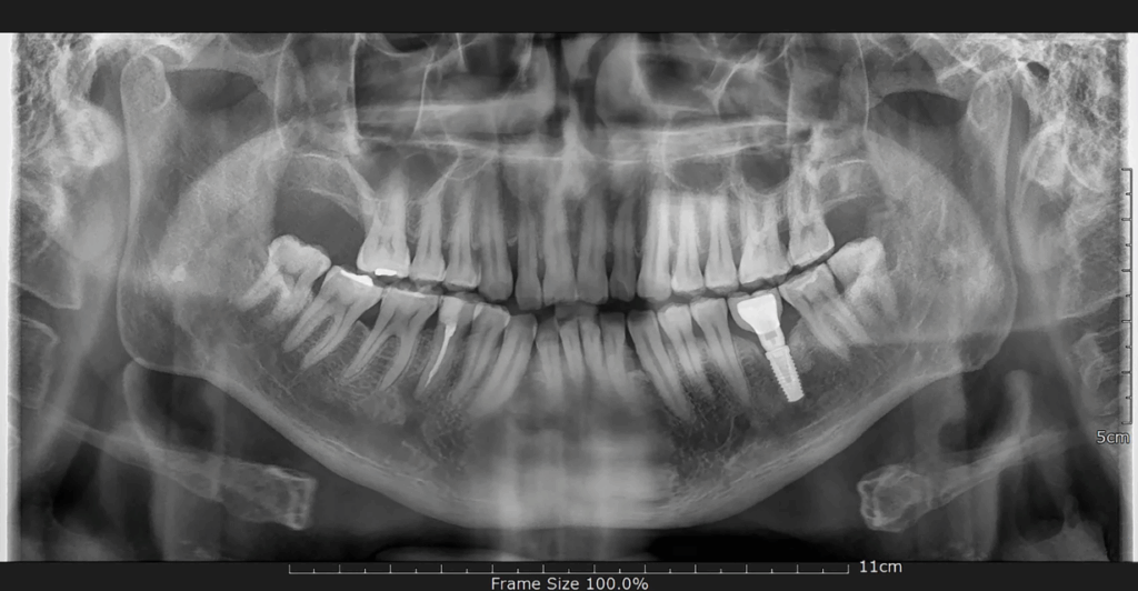 A panoramic dental X-ray showing a dental implant on the lower right side of the jaw