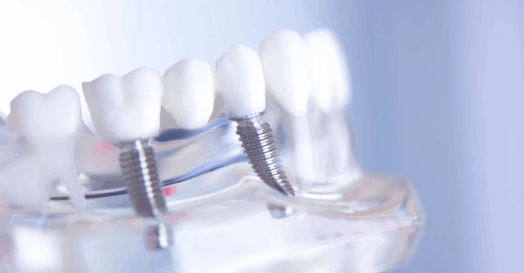 (A close-up of a dental implant model showing titanium posts integrated with artificial teeth.)